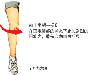 前十字韧带损伤 在固定脚部的状态下施加剧烈的回旋力，膝盖会向前方摇晃。 *图为右脚