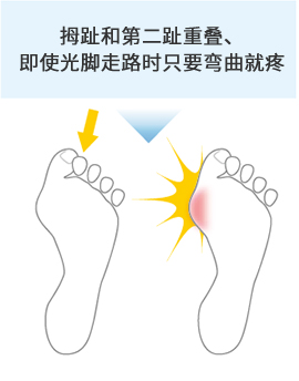 拇趾和第二趾重叠、即使光脚走路时只要弯曲就疼